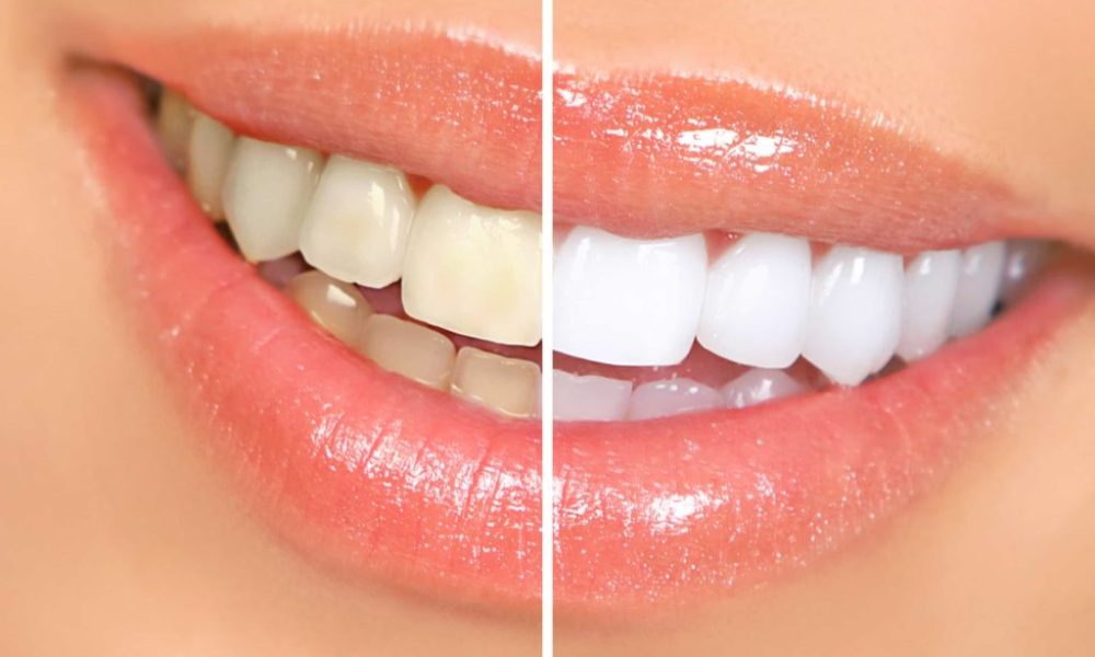 Teeth Whitening Method | Perry Family Dentistry | Mount Vernon, WA