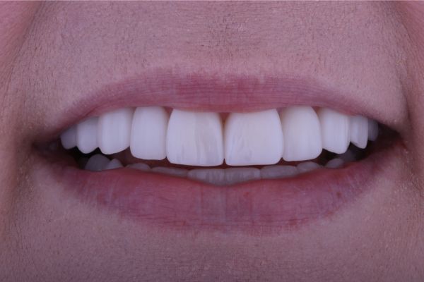 Close-up of a person's smile showing straight, white teeth after a dental transformation.