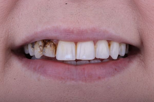 Close-up of a person's smile showing discolored, decayed, and misaligned teeth, possibly before dental treatment.
