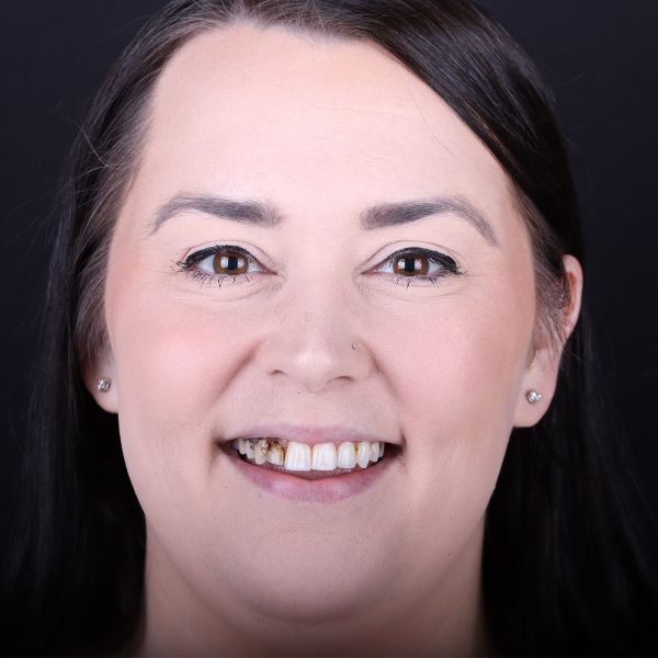 Close-up of a woman with dark hair smiling, showing uneven and discolored teeth, possibly before dental transformation.