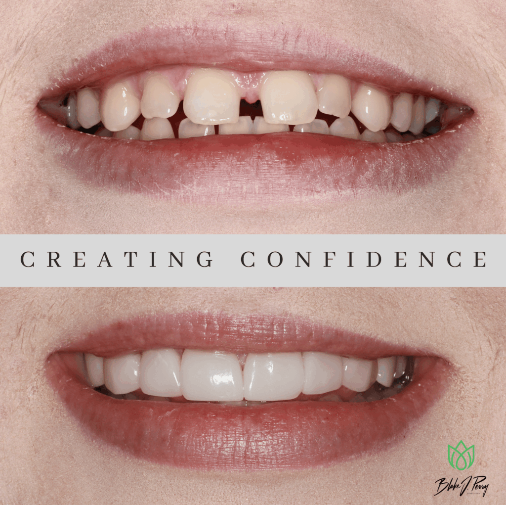 before and after comparison with veneers