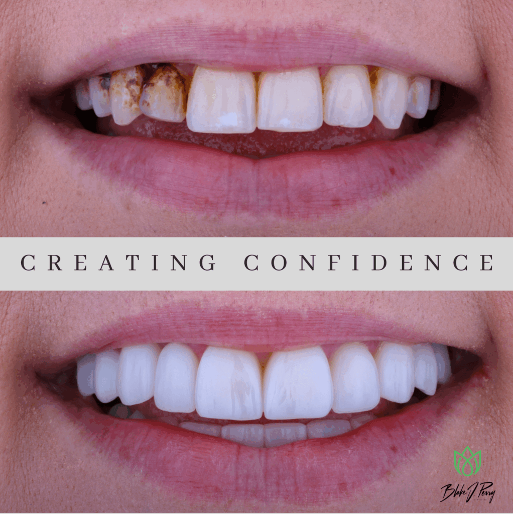enhanced smile with veneers