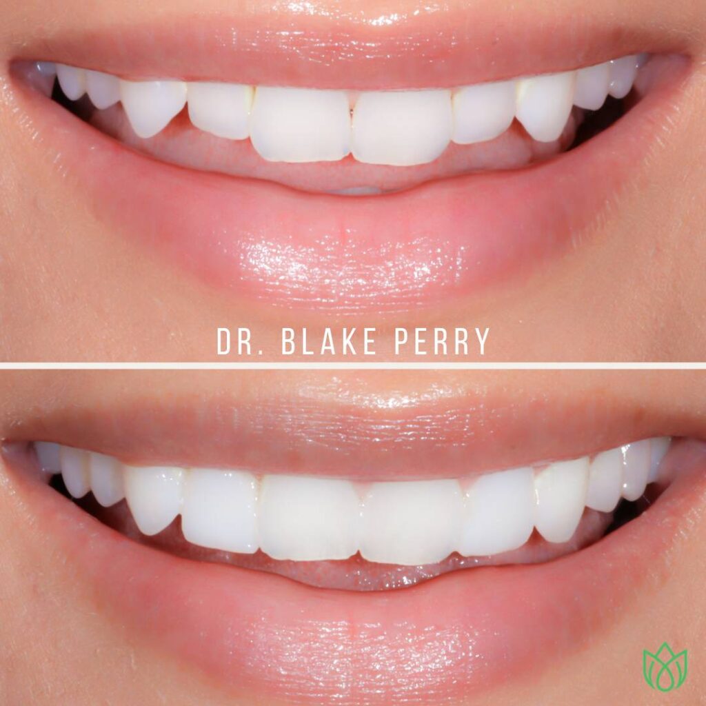 Close-up of teeth before and after smile by Dr. Blake J Perry