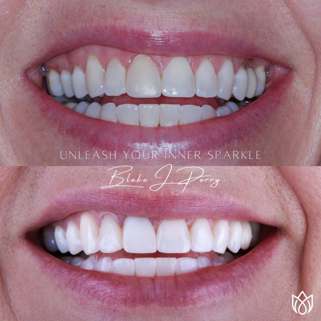 Close-up of teeth pre and post-dentistry by Dr. Blake Perry.