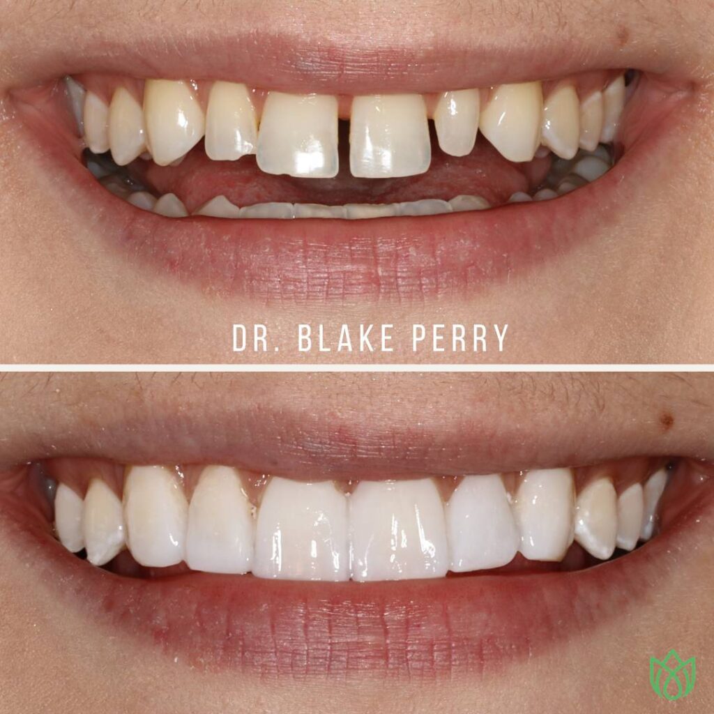 Close-up of teeth before and after smile by Dr. Blake J Perry