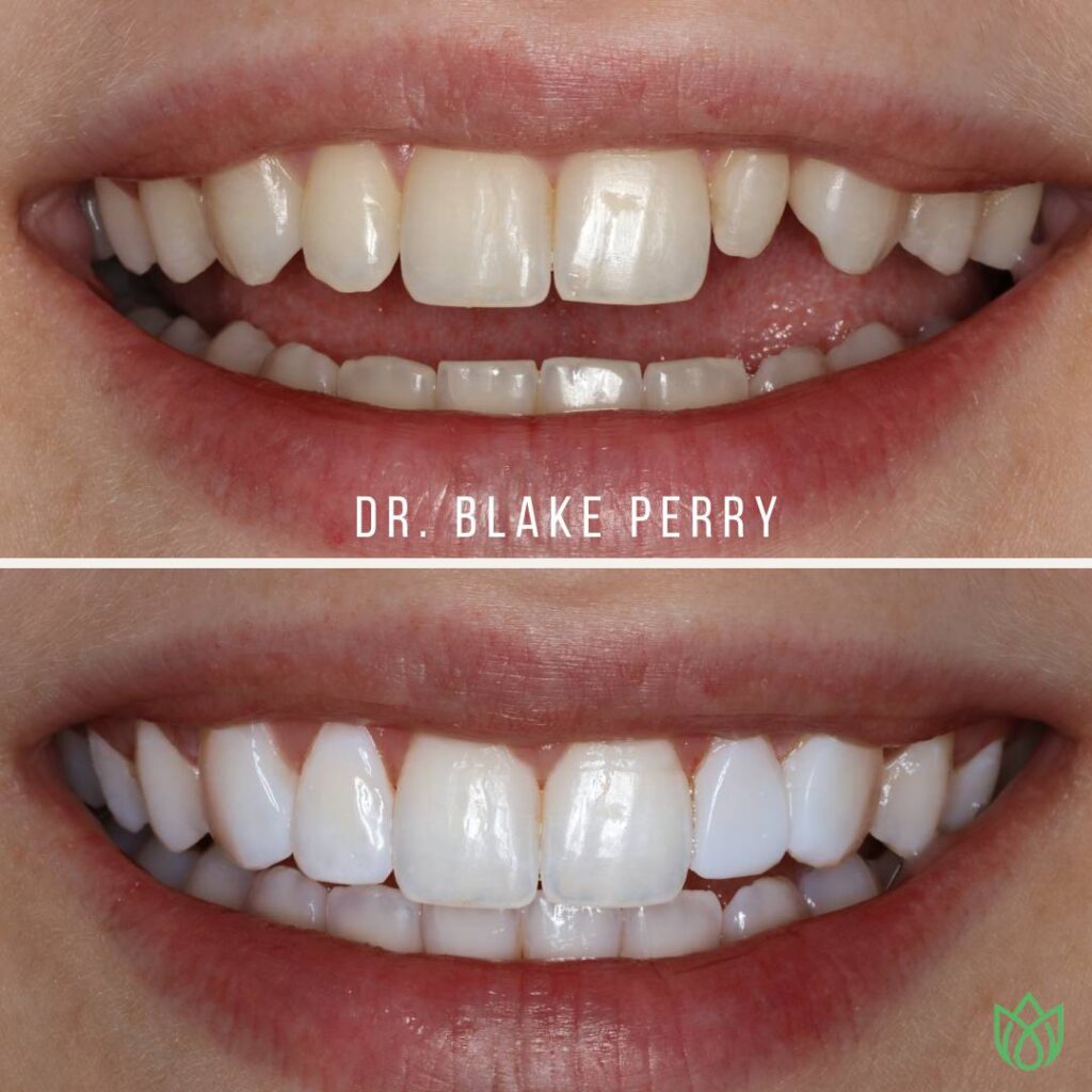 Close-up of teeth pre & post-dentistry by Dr. Blake J Perry